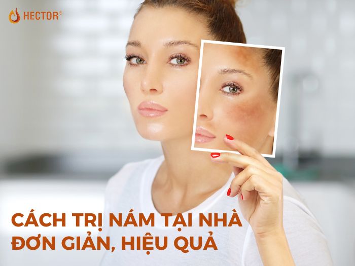 Top 15 cách trị nám tại nhà đơn giản mà các spa đang giấu kín