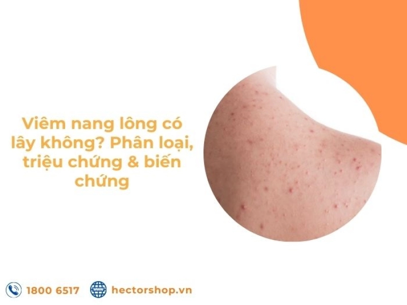 Viêm nang lông có lây không? Phân loại, triệu chứng, biến chứng