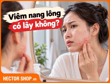 Viêm Nang Lông Có Lây Không? Khi Nào Có Nguy Cơ Lây?